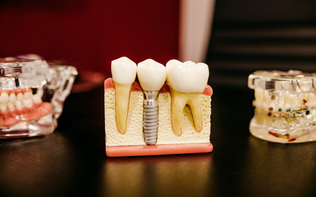 The Significance of Dental Implants
