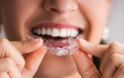 Clear Aligners: The Future of Orthodontics Made Easy